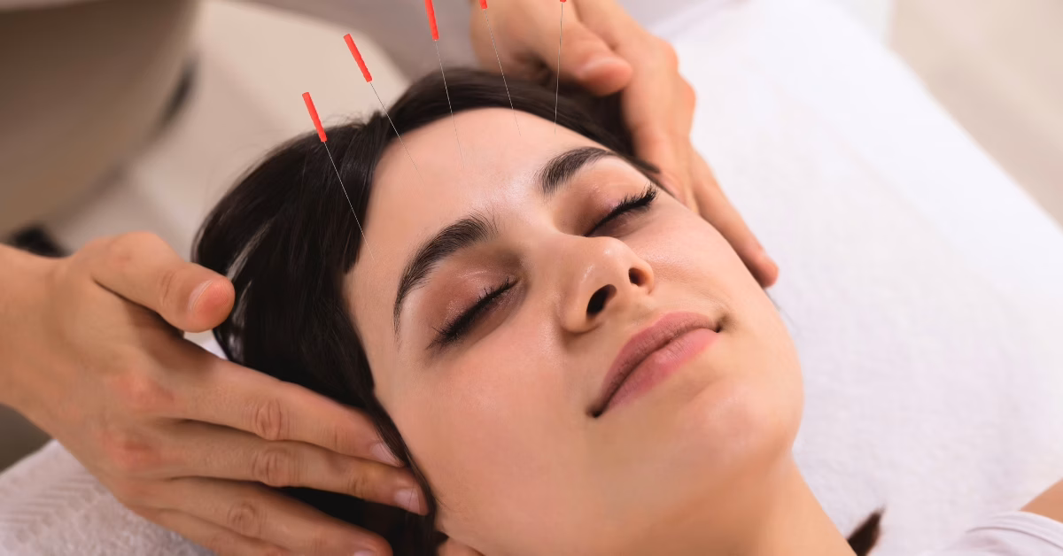 Mulher relaxada recebendo acupuntura facial para aliviar ansiedade e promover bem-estar.